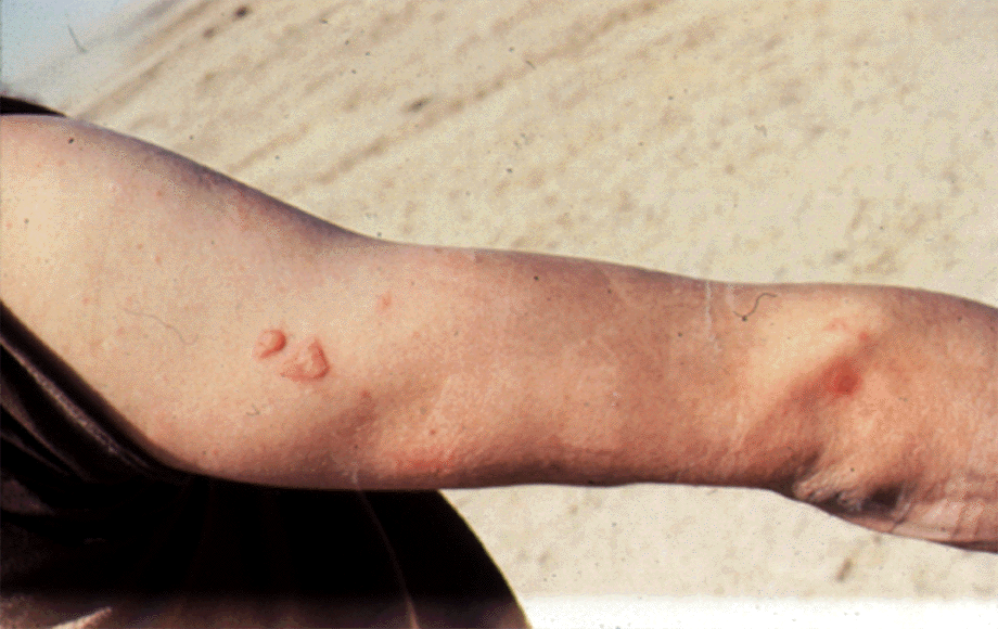 Figure 5.  Private Fisher blister injury -  Dr. Dunn photo 1